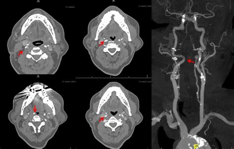 Internal Carotid Artery and Its Aneurysms | neuroangio.org