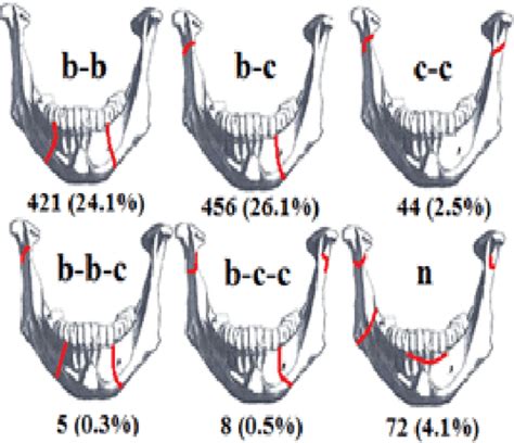 [PDF] A Proposed Easy-to-Use Classification of Mandibular Fractures ...