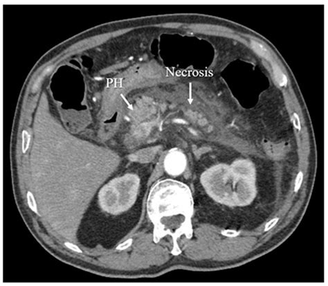 Diagnostics | Free Full-Text | Diagnosis and Treatment of Acute ...