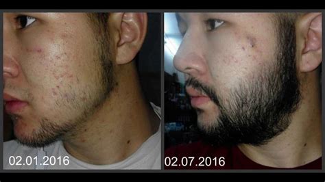 Minoxidil Beard Before And After Pictures For a lot of men growing a ...