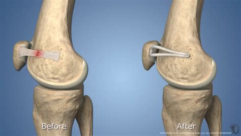 Medial Patellofemoral Ligament (MPFL) Reconstruction | HSS