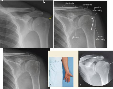 Shoulder X-Rays (position, projection, & view) Flashcards | Quizlet