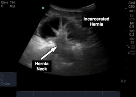 Point of Care Ultrasound for Hernias — Takeokun.com