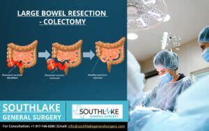 Large Bowel Resection (Colectomy) Procedure - Southlake General Surgery