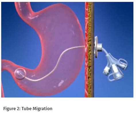 Gastrostomy, transgastric–jejunal, jejunal tube care