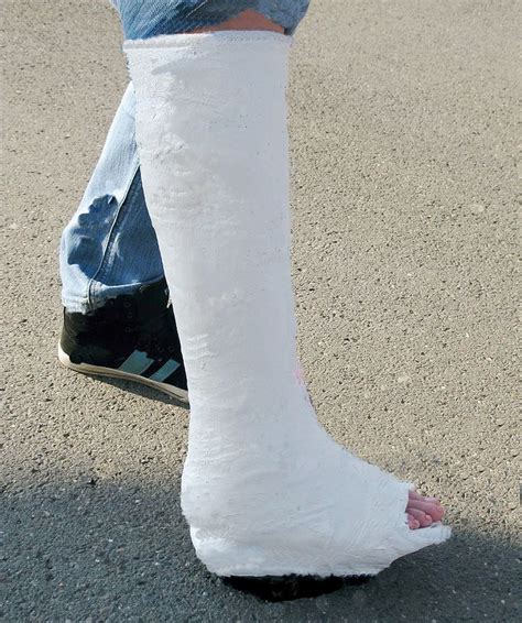 Plaster leg cast, walking cast, toeplate SLWC | Leg cast, Walking cast ...