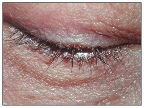 Infestation of the eyelashes with Phthirus pubis | CMAJ