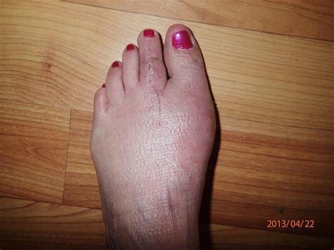 Recovery After Bunion Hammer Toe Surgery - Marlys Vandekamp