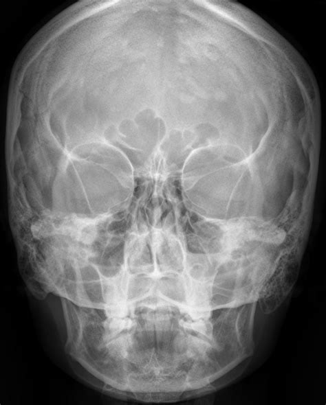 Maxillary Fracture