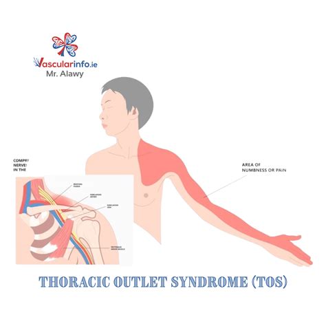 Thoracic Outlet Syndrome - Vascular Info