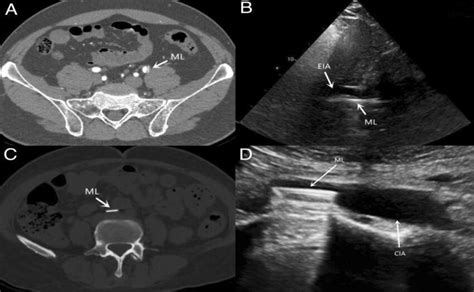 CT and ultrasound data of the escape bileaflet. A Ten years after the ...