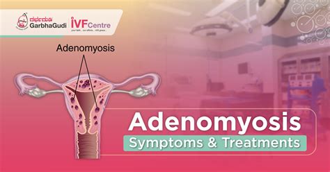 Adenomyosis Symptoms & Treatments