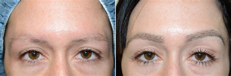 Eyebrow Transplantation Photos | Miami, FL | Patient 15825