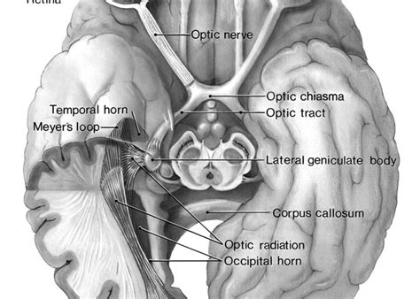 Anatomy of the Visual Pathways from the Temporal Horn to the Visual ...