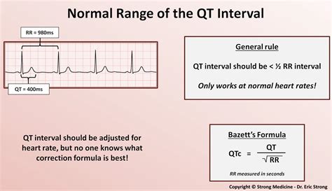 Normal Ekg Strip Measurements