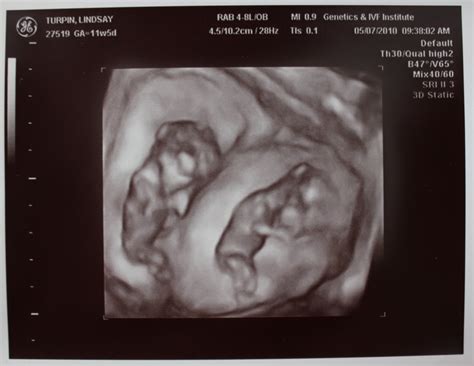 Adventures in Baby Making: 12 weeks ultrasound