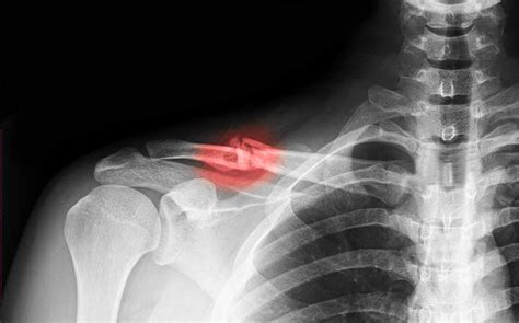 Shoulder Fracture | Shoulder Specialist | Van Nuys, Thousand Oaks, Los ...