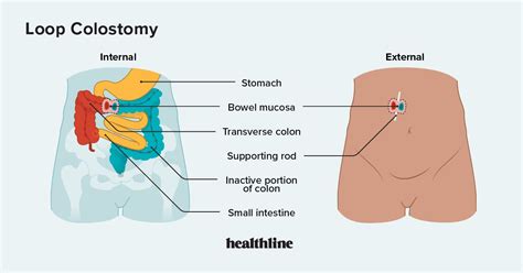 Loop Colostomy: What You Should Know