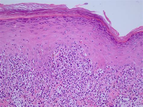 Interface dermatitis: Lichenoid infiltration, hypergranulosis, and ...