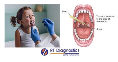 Culture & Sensitivity - Throat Swab | RT Diagnostics