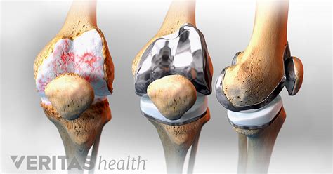 When to Consider Knee Replacement Surgery