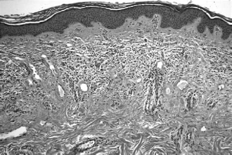 Microscopic characteristics of the lichenoid dermatitis in our Wilson ...