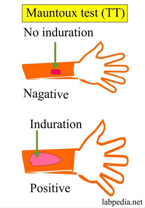 Mycobacterium Tuberculosis:- Part 2 - Mantoux test, TT, Tuberculin skin ...