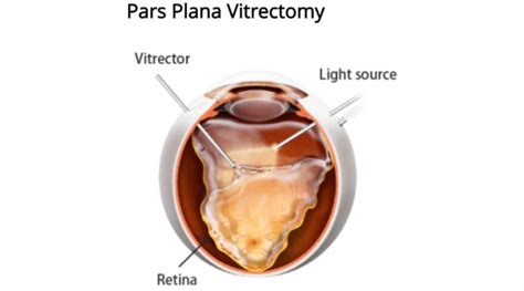 How to Educate Patients for Pars Plana Vitrectomy (PPV) | OBN