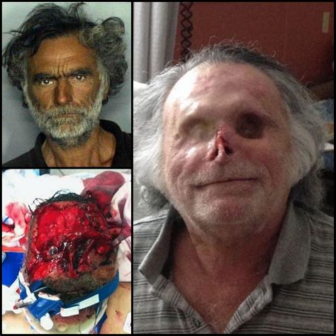 Face of Ronald Poppo - victim of a canibal attack : r/MedicalGore