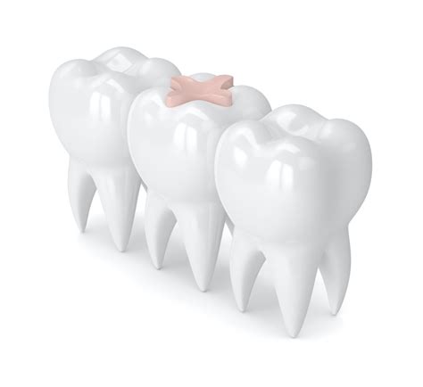 Is Cavity Treatment Permanent? - General Dentist in Laurel, MD