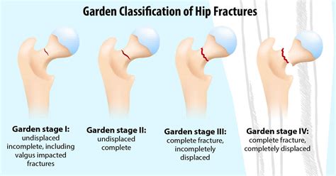 Femoral neck fracture causes, types, symptoms, diagnosis, treatment ...