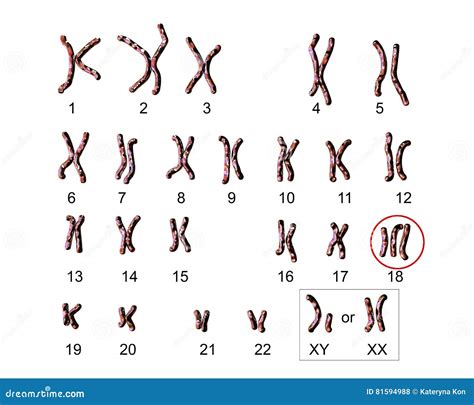 Edwards Syndrome Karyotype Stock Image | CartoonDealer.com #51855667