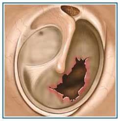 Perforated Eardrum - Symptoms, Causes, Diagnosis And Prevention