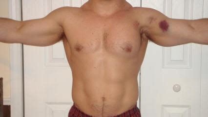 Pec Tear - Pectoralis Major Tears/Rupture | 321GOMD