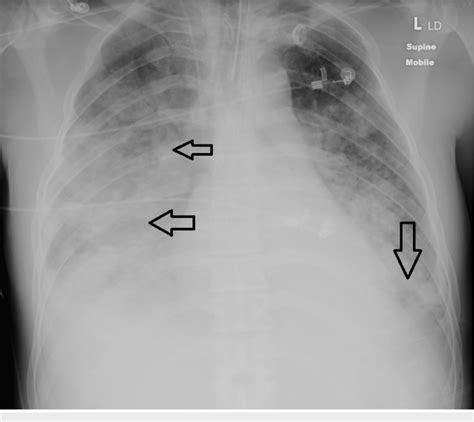 Pulmonary Venous Congestion Chest X Ray | SexiezPicz Web Porn