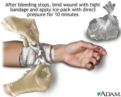 Stopping bleeding with pressure and ice: MedlinePlus Medical ...