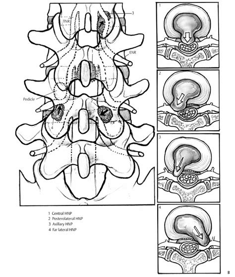 Clinical Features of Herniated Nucleus Pulposus | Neupsy Key