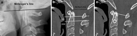 Atlantoaxial Joint Subluxation