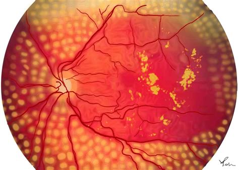 Panretinal Photocoagulation Laser (PRP)