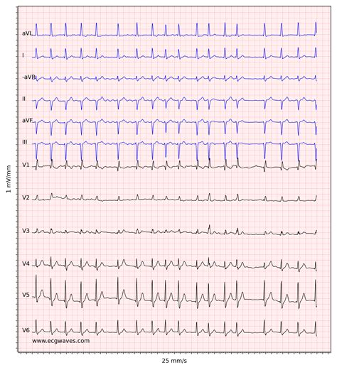 Atrial fibrillation: ECG, classification, causes, risk factors ...