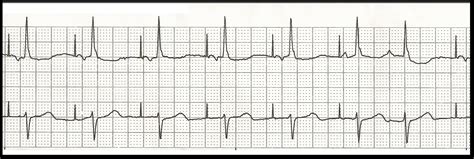 Float Nurse: EKG Rhythm Strip Quiz 100: Paced rhythms