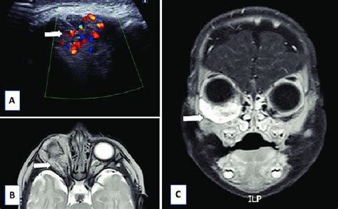 Orbital hemangioma. A: Ultrasound, longitudinal section, at the level ...