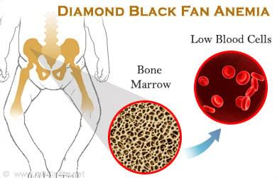 Diamond Blackfan Anemia: Symptoms, Causes, Treatment, Diagnosis