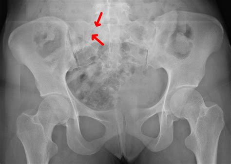 Icd 10 Code For Transverse Process Fracture L5