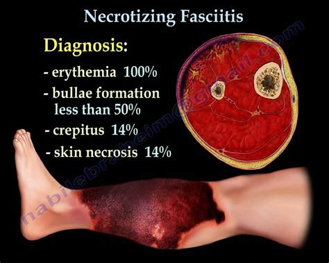 Necrotizing Fasciitis part I, flesh eating bacteria.Everything You Need ...