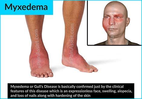 Myxedema or Gull's Disease is found more in females than males ...