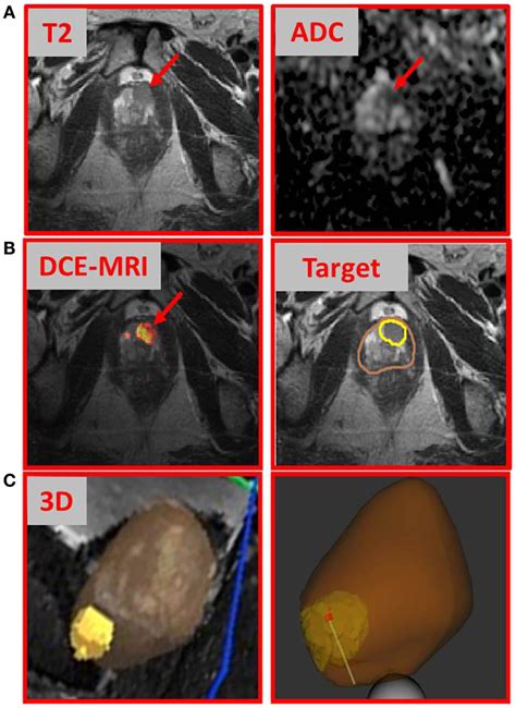 Multiparametric-MRI findings and directed prostate biopsy of the index ...