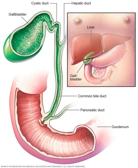 Cholecystitis - Symptoms and causes - Mayo Clinic