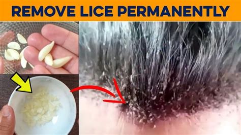 How to Get Rid of Lice Permanently in 1 Hour - Remove Lice Eggs from ...