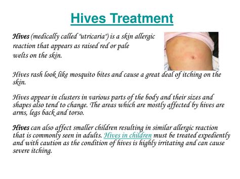 PPT - hives treatment PowerPoint Presentation, free download - ID:62620